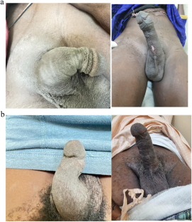 Penile prosthesis for erectile dysfunction: early experience in Senegal, West Africa