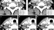 Enhancement on CT for preoperative diagnosis of metastatic lymph nodes in thyroid cancer: a comparison across experience levels.