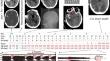 Lessons to Learn from Multimodal Neuromonitoring of Brain Death with Electrophysiological Markers of Cortical and Subcortical Loss of Functions.