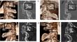 Does ponticulus posticus affect vertebral artery diameter.