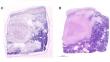 Fluorescence confocal microscopy for evaluation of fresh surgical specimens and consecutive tumor cell isolation in rare pediatric tumors.