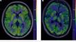 Frontal-striatal glucose metabolism and fatigue in patients with multiple sclerosis, long COVID, and COVID-19 recovered controls.