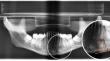 Mandibular bone mass density in a medieval population and its relationship with stable isotopes δ13C and δ15N.