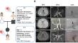 FOXM1 c.1205 C > A mutation is associated with unilateral Moyamoya disease and inhibits angiogenesis in human brain endothelial cells.