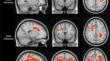 Evaluation of microstructural changes in the brain in transfusion dependent thalassemia patients with advanced magnetic resonance imaging techniques.