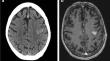 To scan or not to scan? A retrospective cohort study analysing the efficacy of routine post-operative CT after brain biopsy.