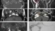 The intrabulbar or extrabulbar growth pattern and its surgical outcomes of jugular foramen paragangliomas.