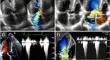 Severe mitral regurgitation in non-hypertrophic cardiomyopathy caused by systolic anterior motion of the mitral valve.