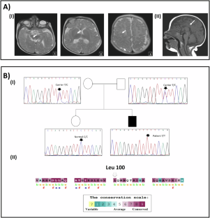 Characterization of a missense variant in COG5 in a Tunisian patient with COG5-CDG syndrome and insights into the effect of non-synonymous variants on COG5 protein.