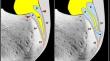 Dynamic ultrasound assessment for insertional achilles tendinopathy: the COcco-RIcci (CORI) sign.