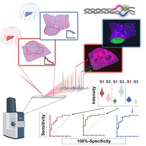 The Spatial Extracellular Proteomic Tumor Microenvironment Distinguishes Molecular Subtypes of Hepatocellular Carcinoma.