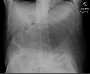 Complications in spinal cord injury persons with "traditional" colostomy: a case series.