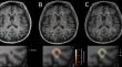 Microstructural characterization of multiple sclerosis lesion phenotypes using multiparametric longitudinal analysis.