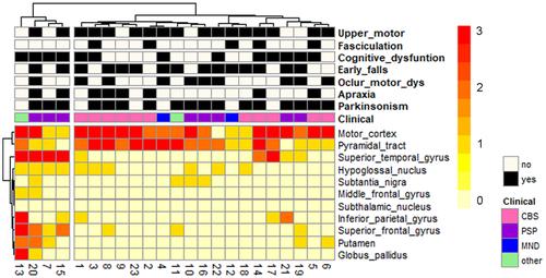 Upper motor neuron-predominant motor neuron disease presenting as atypical parkinsonism: A clinicopathological study.