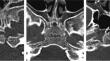 Mystery of the Muenke midface: spheno-occipital synchondrosis fusion and craniofacial skeletal patterns.