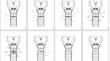 The dragonfly technique for trachea closure in temporary tracheostomies. Surgical steps and clinical results.