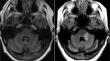 De-escalation and Discontinuation of Disease-Modifying Therapies in Multiple Sclerosis.