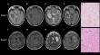 Super T2-FLAIR mismatch sign: a prognostic imaging biomarker for non-enhancing astrocytoma, IDH-mutant.