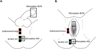 Bedside electromyography for clinical assessment of sacral motor and reflex activity adapted for patients hospitalized with acute neurological conditions: a pilot study.