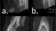 Ultrasound can provide an early assessment of infection of cartilage structures in infants.