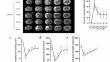 The expression profile of brain-derived exosomal miRNAs reveals the key molecules responsible for spontaneous motor function recovery in a rat model with permanent middle cerebral artery occlusion.