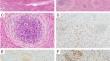 Endometrial stromal tumor with whorling and GREB1::CTNNB1 fusion-a case report on a rare entity.