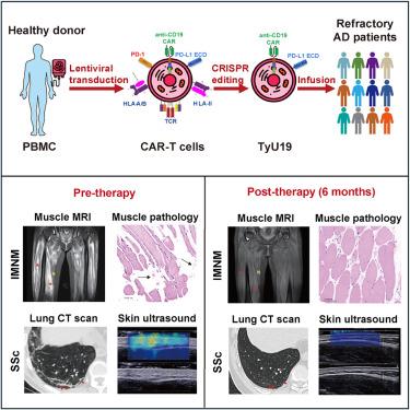 Allogeneic CD19-targeted CAR-T therapy in patients with severe myositis and systemic sclerosis