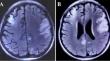 X-linked agammaglobulinaemic progressive encephalopathy mimicking mitochondrial encephalomyopathy-latic axidosis-stroke like episode.