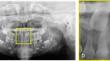 Deep learning with convolution neural network detecting mesiodens on panoramic radiographs: comparing four models.