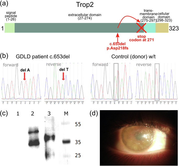 TACSTD2 in gelatinous drop-like corneal dystrophy: variant functional analysis and expression in the cornea after limbal stem cell transplantation.