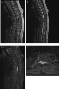 Pure epidural extraosseous cavernous hemangioma with thoracic myelopathy: case report and review of literature.