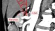 Pancreas-left gastric artery angle predicts difficulty of suprapancreatic lymph node dissection in gastrectomy for gastric cancer: a cross-sectional study.