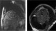 Cardiac Sarcoidosis: Utilizing Cardiac MRI and PET-CT.