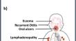 A novel MALT1 variant in an Egyptian patient presenting with exfoliative dermatitis: a case-based review.