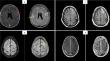 Rheumatoid meningitis: a case series report and review of modern therapeutic schemes and outcome.