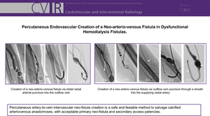 Percutaneous Endovascular Creation of a Neo-arteriovenous Fistula in Dysfunctional Hemodialysis Fistulas.