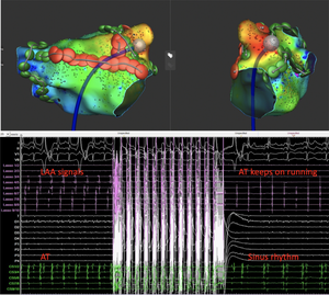 Durable LAA isolation combining pulsed field ablation and radiofrequency linear lesions in a patient with a therapy refractory left atrial appendage tachycardia.