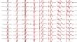 Interactions between arm and leg neuronal circuits following paired cervical and lumbosacral transspinal stimulation in healthy humans.