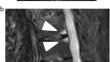 Standardized reporting of spine and sacroiliac joints in axial spondyloarthritis MRI: from the ESSR-Arthritis Subcommittee.