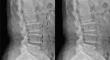 Association of Abdominal Aortic Calcification and Clinical Outcomes in LDH Patients Treated with Endoscopic Lumbar Discectomy.