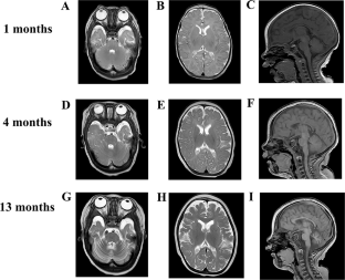 INTS11-related neurodevelopmental disorder: a case report and literature review.