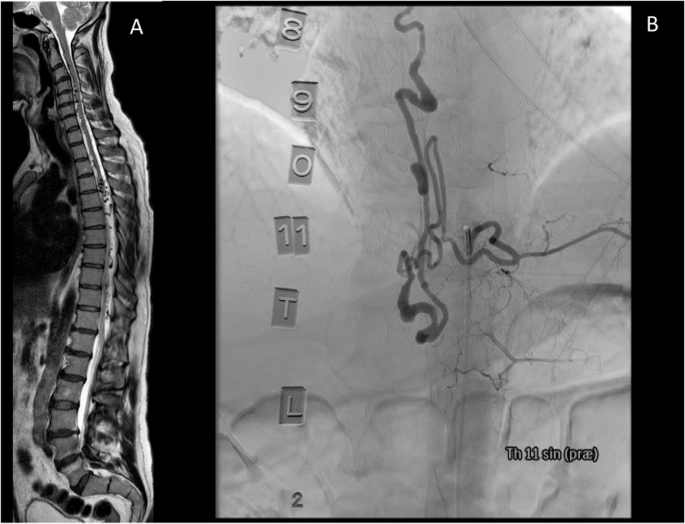 A rare case of spinal involvement in hereditary hemorrhagic telangiectasia.