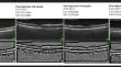 Investigation of choroidal structure changes after intravitreal anti-VEGF therapy for retinal vein occlusion.