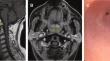 Fluoroscopy-Guided Balloon Dilation for Severe Nasopharyngeal Stenosis Resulting from Radiotherapy for Nasopharyngeal Carcinoma.