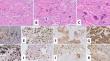 Giant cell carcinoma of the urinary bladder : Clinicopathologic analysis and oncological outcomes.