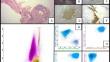 Paraneoplastic glomerulonephritis and kidney infiltration by mantle cell lymphoma: A diagnostic challenge.