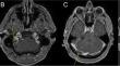 The effect of SARS-CoV-2 on the incidence of post-operative venous sinus thrombosis following skull base procedures.