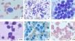 An unusual case of pure erythroid leukemia with normal karyotype and NPM1 mutation.