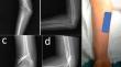 Successful Management of a Pediatric Patient with Humeral Lateral Condyle Non-union, Elbow Valgus Deformity and Ulnar Neuropathy