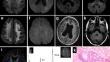 Clinical and multimodal imaging features of adult-onset neuronal intranuclear inclusion disease.